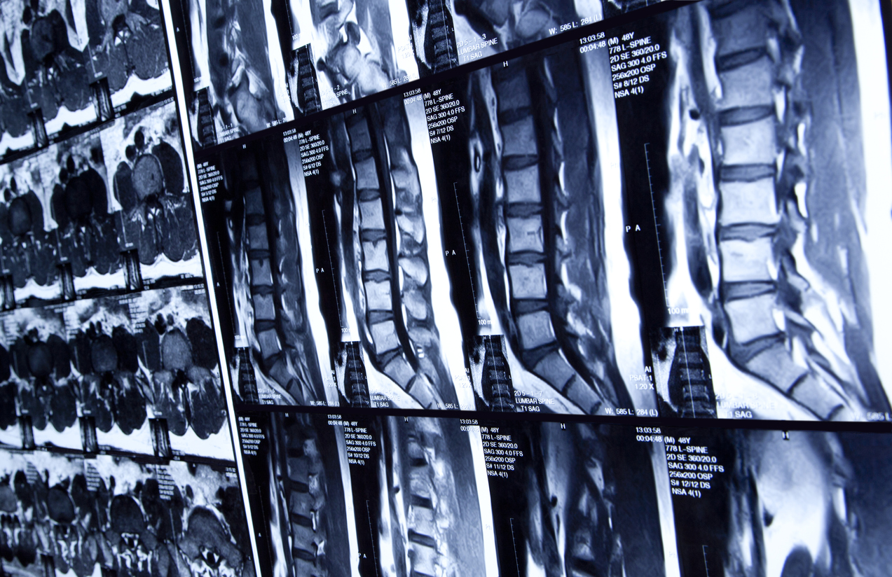 MRI scan of lumbar spine