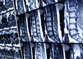 MRI scan of lumbar spine