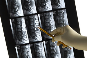 spine colman implants