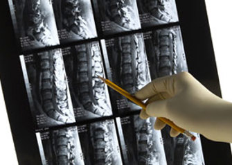 spine colman implants