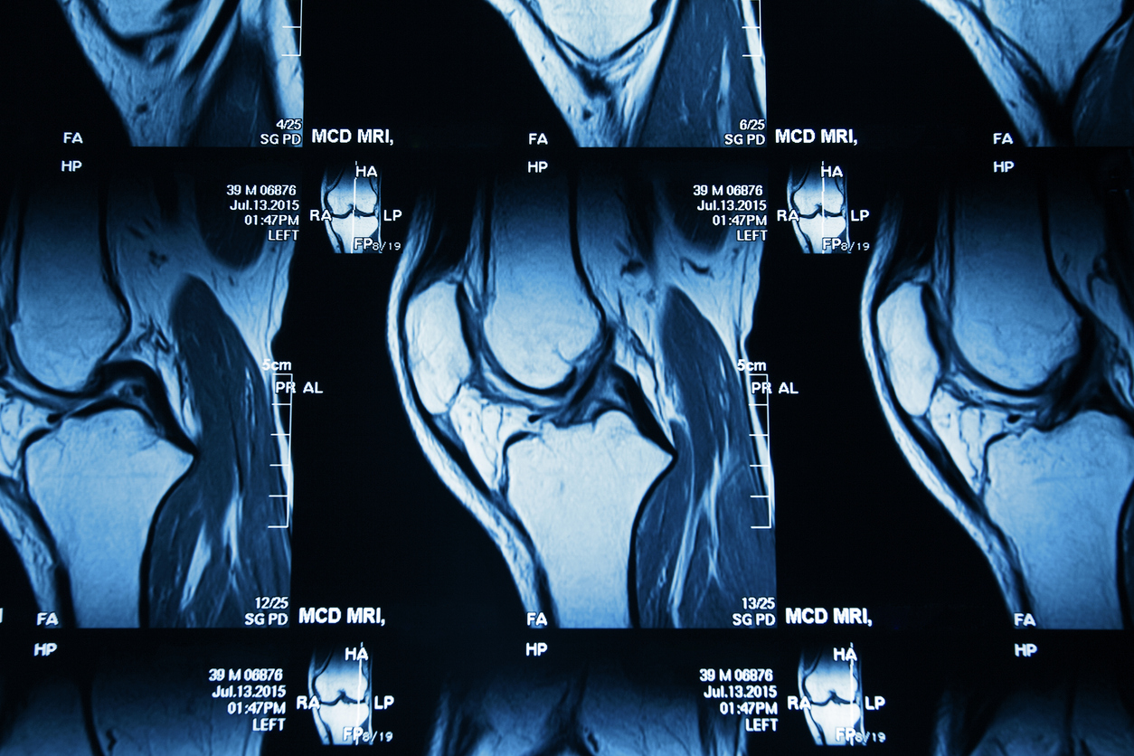 knee mri