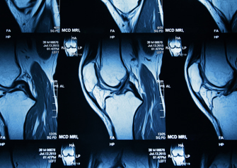 knee mri