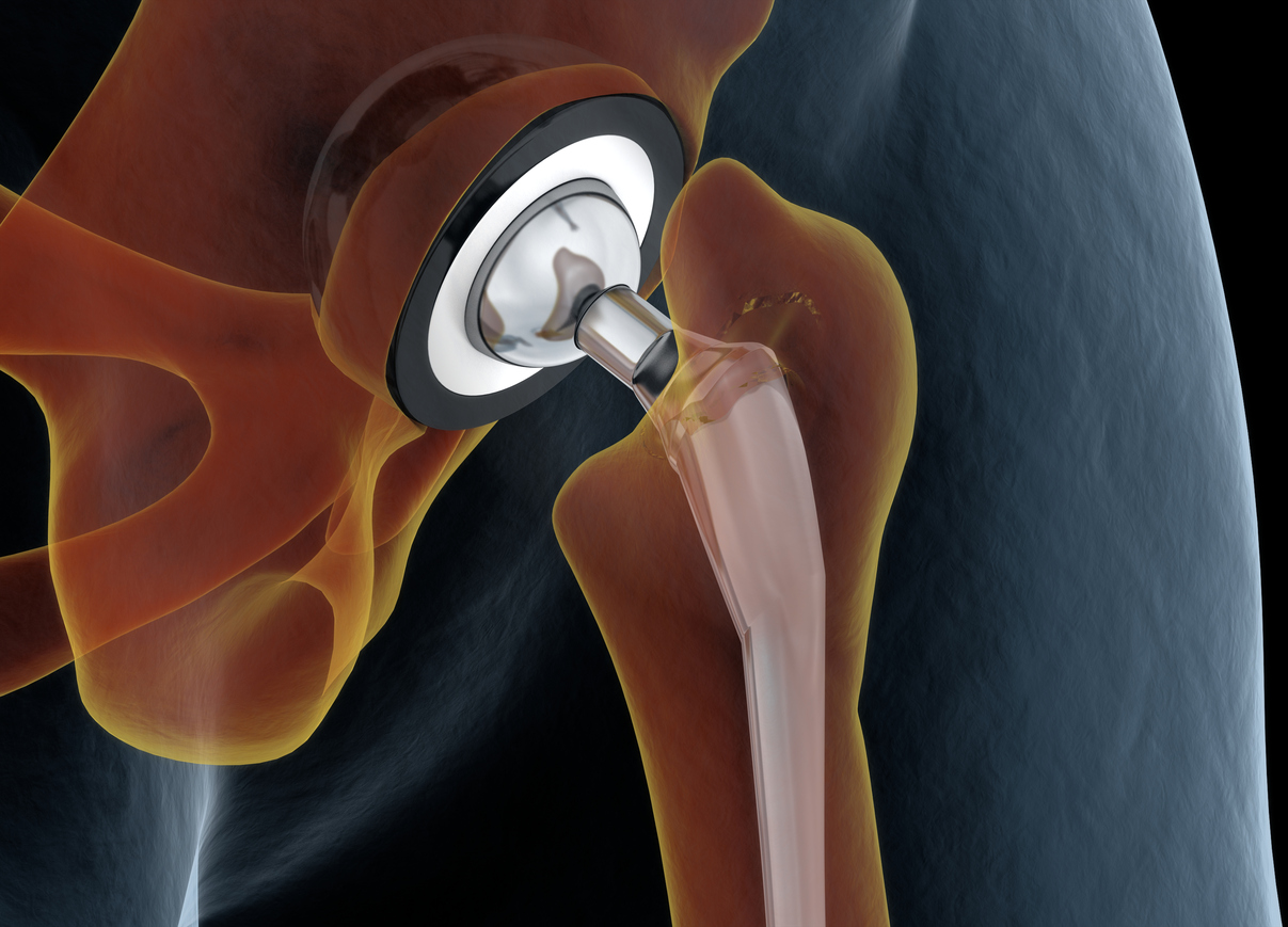 joint replacement