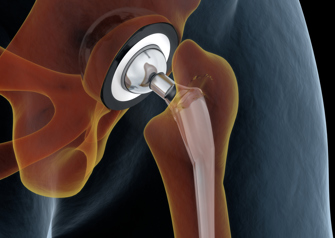 joint replacement