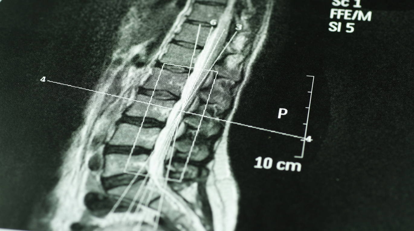 MRI scan of a spine