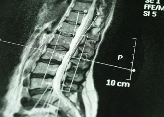 MRI scan of a spine