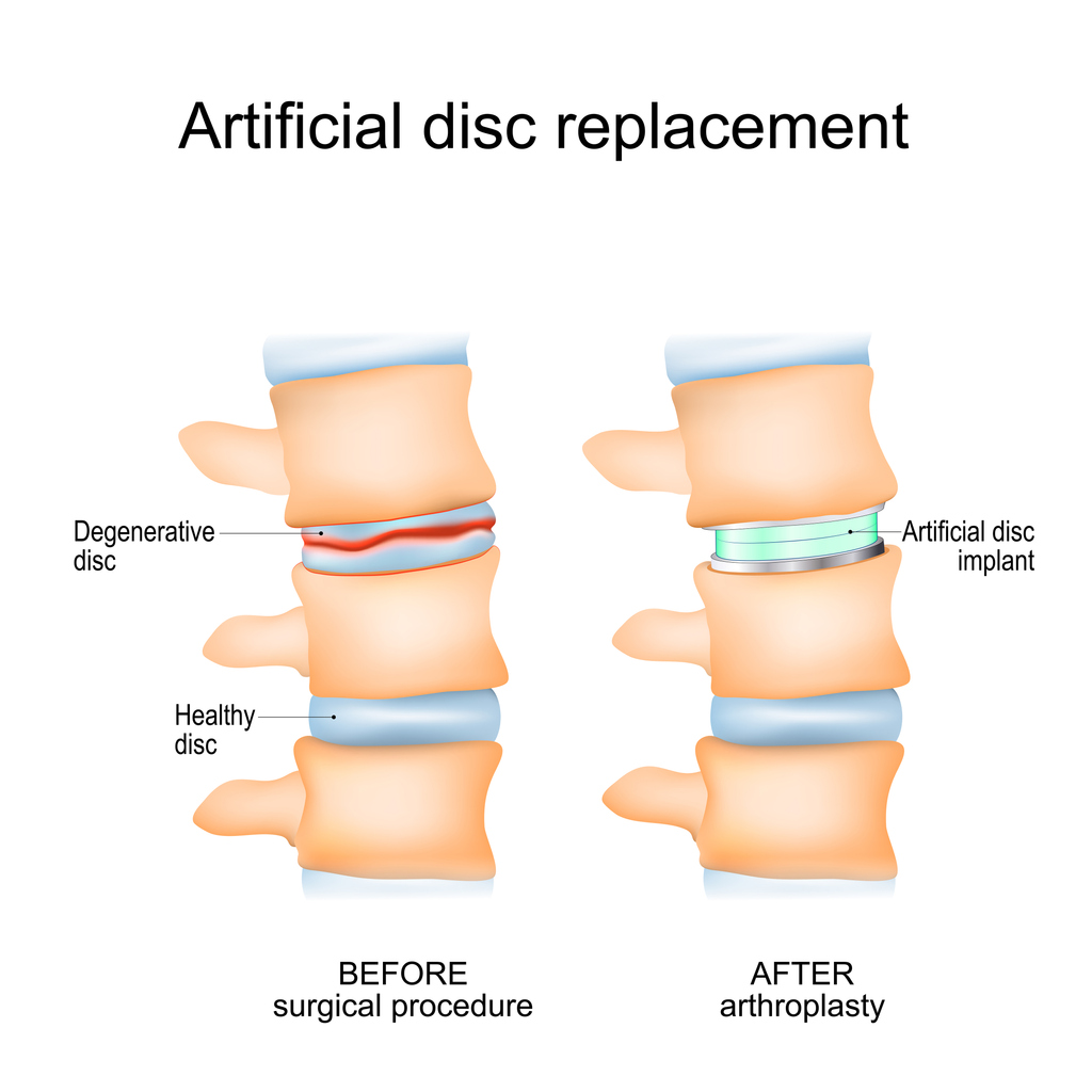 What You Need To Know About Cervical Disc Replacements